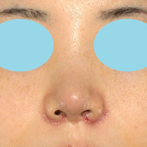 「耳介軟骨移植＋鼻尖縮小（close法）＋小鼻縮小+α」　新宿ラクル美容外科クリニック　２０代女性　手術後１週間目　３月２９日