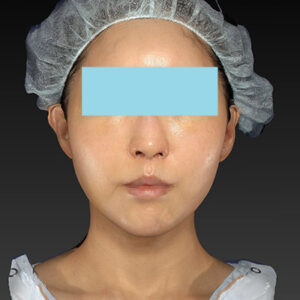 新宿ラクル美容外科クリニック　山本厚志　「アルテミスリフト」　手術後１週間目　３月３０日