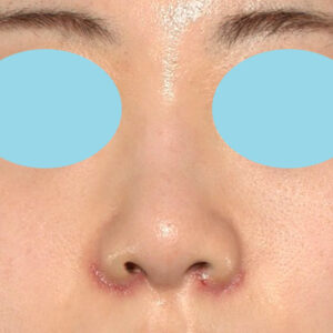 新宿ラクル美容外科クリニック　山本厚志　「貴族手術（鼻翼基部プロテーゼ）＋ 小鼻縮小+α法」　手術後１週間目　３月３１日