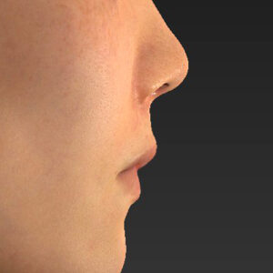 新宿ラクル美容外科クリニック　山本厚志　「猫手術（鼻唇角形成術）+ 貴族手術（鼻翼基部プロテーゼ）」　手術後１週間目　３月１日