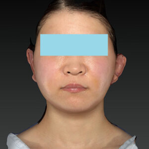 新宿ラクル美容外科クリニック　山本厚志　「ナチュラルフェイスリフト」「ライポライフ脂肪吸引（メーラーファット+ジョールファット）」　手術後１週間目　３月２０日