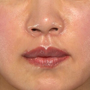 新宿ラクル美容外科クリニック　山本厚志　「外側人中短縮術（上口唇挙上術）+ 人中短縮術（リップリフト）＋口唇縮小」　手術後１ヶ月目　３月２８日