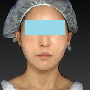 新宿ラクル美容外科クリニック　山本厚志　「アルテミスリフト」　手術後１ヶ月目　３月３０日