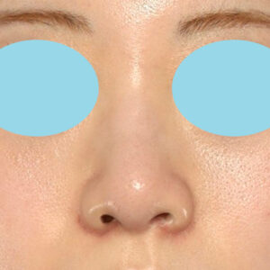 新宿ラクル美容外科クリニック　山本厚志　「貴族手術（鼻翼基部プロテーゼ）＋ 小鼻縮小+α法」　手術後１ヶ月目　３月３１日