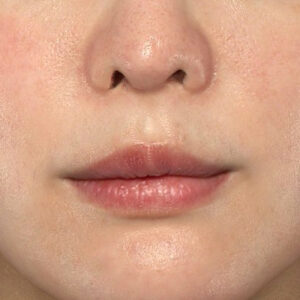 新宿ラクル美容外科クリニック　山本厚志　「貴族手術（鼻翼基部プロテーゼ）」　手術後１ヶ月目　３月５日