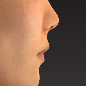 新宿ラクル美容外科クリニック　山本厚志　「猫手術（鼻唇角形成術）+ 貴族手術（鼻翼基部プロテーゼ）」　手術後１ヶ月目　３月１日