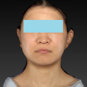 新宿ラクル美容外科クリニック　山本厚志　「ナチュラルフェイスリフト」「ライポライフ脂肪吸引（メーラーファット+ジョールファット）」　手術後１ヶ月目　３月２０日