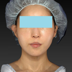 新宿ラクル美容外科クリニック　山本厚志　「アルテミスリフト」　手術後２ヶ月目　３月３０日