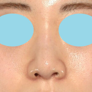 新宿ラクル美容外科クリニック　山本厚志　「貴族手術（鼻翼基部プロテーゼ）＋ 小鼻縮小+α法」　手術後2ヶ月目　３月３１日