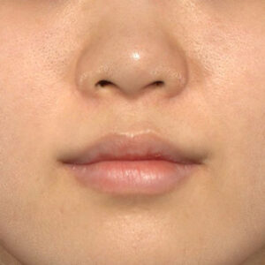 新宿ラクル美容外科クリニック　山本厚志　「猫手術（鼻唇角形成術）+ 貴族手術（鼻翼基部プロテーゼ）」　手術後２ヶ月目　３月２５日