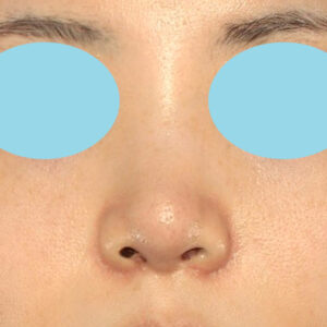 「耳介軟骨移植＋鼻尖縮小（close法）＋小鼻縮小+α」　新宿ラクル美容外科クリニック　２０代女性　手術後２ヶ月目　３月２９日