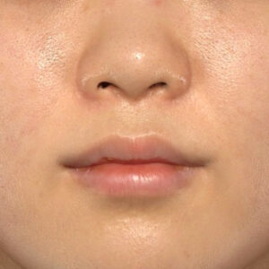 新宿ラクル美容外科クリニック　山本厚志　「猫手術（鼻唇角形成術）+ 貴族手術（鼻翼基部プロテーゼ）」　手術後３ヶ月目　４月１３日