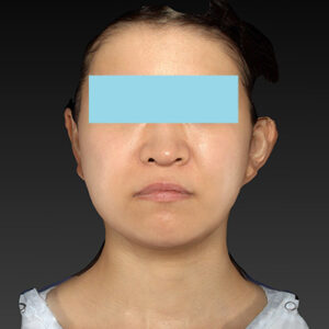 新宿ラクル美容外科クリニック　山本厚志　「ナチュラルフェイスリフト」「ライポライフ脂肪吸引（メーラーファット+ジョールファット）」　手術後３ヶ月目　３月２０日