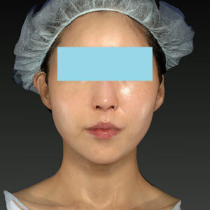 新宿ラクル美容外科クリニック　山本厚志　「アルテミスリフト」　手術後３ヶ月目　３月３０日