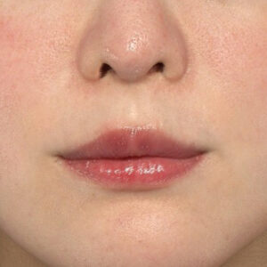 新宿ラクル美容外科クリニック　山本厚志　「貴族手術（鼻翼基部プロテーゼ）」　手術後３ヶ月目　４月７日