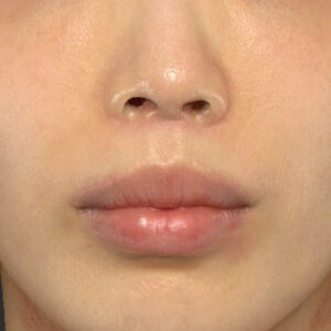 新宿ラクル美容外科クリニック　山本厚志　「外側人中短縮術（上口唇挙上術）+ 人中短縮術（リップリフト）」　手術後３ヶ月目　４月９日