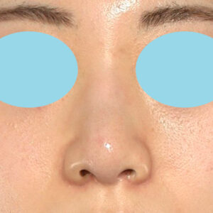 新宿ラクル美容外科クリニック　山本厚志　「貴族手術（鼻翼基部プロテーゼ）＋ 小鼻縮小+α法」　手術後３ヶ月目　４月１０日