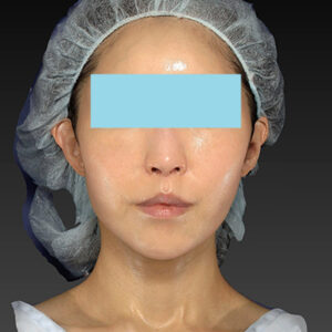 新宿ラクル美容外科クリニック　山本厚志　「アルテミスリフト」　手術後６ヶ月目　３月３０日