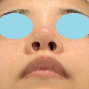 「耳介軟骨移植＋鼻尖縮小（close法）＋小鼻縮小+α」　新宿ラクル美容外科クリニック　２０代女性　手術前　３月２９日