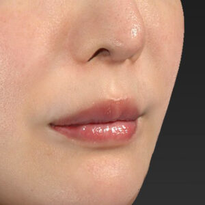 新宿ラクル美容外科クリニック　山本厚志　「貴族手術（鼻翼基部プロテーゼ）」　手術前　３月５日