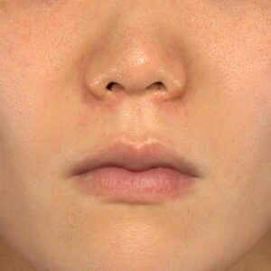 新宿ラクル美容外科クリニック　山本厚志　「猫手術（鼻唇角形成術）+ 貴族手術（鼻翼基部プロテーゼ）」　手術前　３月１日