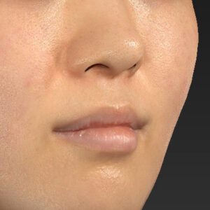 新宿ラクル美容外科クリニック　山本厚志　「猫手術（鼻唇角形成術）+ 貴族手術（鼻翼基部プロテーゼ）」　手術前　３月２５日