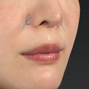 新宿ラクル美容外科クリニック　山本厚志　「貴族手術（鼻翼基部プロテーゼ）」　デザイン　３月５日