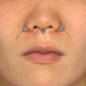 新宿ラクル美容外科クリニック　山本厚志　「猫手術（鼻唇角形成術）+ 貴族手術（鼻翼基部プロテーゼ）」　デザイン　３月１日