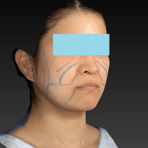 新宿ラクル美容外科クリニック　山本厚志　「ナチュラルフェイスリフト」「ライポライフ脂肪吸引（メーラーファット+ジョールファット）」　デザイン　３月２０日