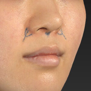 新宿ラクル美容外科クリニック　山本厚志　「猫手術（鼻唇角形成術）+ 貴族手術（鼻翼基部プロテーゼ）」　デザイン　３月２５日