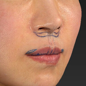 新宿ラクル美容外科クリニック　山本厚志　「外側人中短縮術（上口唇挙上術）+ 人中短縮術（リップリフト）＋口唇縮小」　デザイン　３月２８日