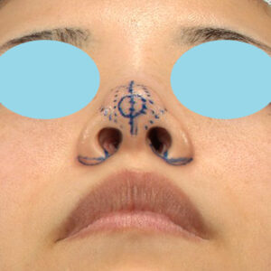 「耳介軟骨移植＋鼻尖縮小（close法）＋小鼻縮小+α」　新宿ラクル美容外科クリニック　２０代女性　デザイン　３月２９日