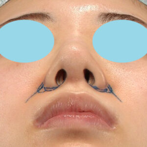 新宿ラクル美容外科クリニック　山本厚志　「貴族手術（鼻翼基部プロテーゼ）＋ 小鼻縮小+α法」　デザイン　３月３１日