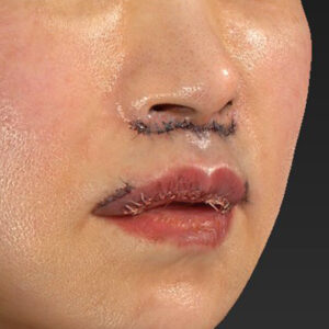 新宿ラクル美容外科クリニック　山本厚志　「外側人中短縮術（上口唇挙上術）+ 人中短縮術（リップリフト）＋口唇縮小」　手術直後　３月２８日