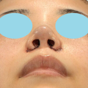 「耳介軟骨移植＋鼻尖縮小（close法）＋小鼻縮小+α」　新宿ラクル美容外科クリニック　２０代女性　手術直後　３月２９日