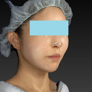 新宿ラクル美容外科クリニック　山本厚志　「アルテミスリフト」　手術直後　３月３０日