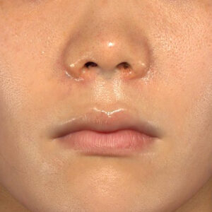 新宿ラクル美容外科クリニック　山本厚志　「猫手術（鼻唇角形成術）+ 貴族手術（鼻翼基部プロテーゼ）」　手術直後　３月１日