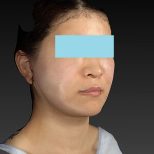 新宿ラクル美容外科クリニック　山本厚志　「ナチュラルフェイスリフト」「ライポライフ脂肪吸引（メーラーファット+ジョールファット）」　手術直後　３月２０日