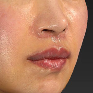 新宿ラクル美容外科クリニック　山本厚志　「外側人中短縮術（上口唇挙上術）+ 人中短縮術（リップリフト）＋口唇縮小」　手術後１週間目　３月２８日