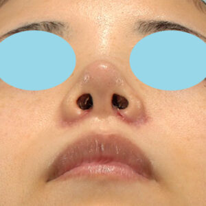 「耳介軟骨移植＋鼻尖縮小（close法）＋小鼻縮小+α」　新宿ラクル美容外科クリニック　２０代女性　手術後１週間目　３月２９日