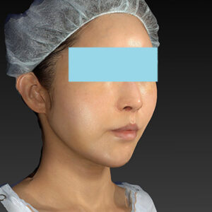 新宿ラクル美容外科クリニック　山本厚志　「アルテミスリフト」　手術後１週間目　３月３０日