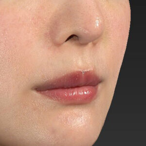 新宿ラクル美容外科クリニック　山本厚志　「貴族手術（鼻翼基部プロテーゼ）」　手術後１週間目　３月５日