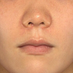 新宿ラクル美容外科クリニック　山本厚志　「猫手術（鼻唇角形成術）+ 貴族手術（鼻翼基部プロテーゼ）」　手術後１週間目　３月１日