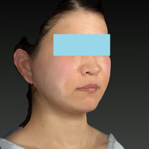 新宿ラクル美容外科クリニック　山本厚志　「ナチュラルフェイスリフト」「ライポライフ脂肪吸引（メーラーファット+ジョールファット）」　手術後１週間目　３月２０日