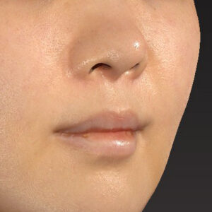 新宿ラクル美容外科クリニック　山本厚志　「猫手術（鼻唇角形成術）+ 貴族手術（鼻翼基部プロテーゼ）」　手術後１週間目　３月２５日