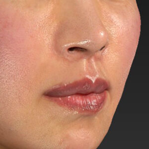 新宿ラクル美容外科クリニック　山本厚志　「外側人中短縮術（上口唇挙上術）+ 人中短縮術（リップリフト）＋口唇縮小」　手術後１ヶ月目　３月２８日