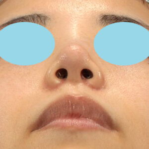 「耳介軟骨移植＋鼻尖縮小（close法）＋小鼻縮小+α」　新宿ラクル美容外科クリニック　２０代女性　手術後１ヶ月目　３月２９日