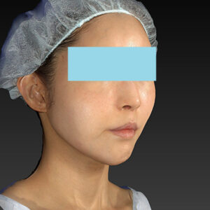 新宿ラクル美容外科クリニック　山本厚志　「アルテミスリフト」　手術後１ヶ月目　３月３０日