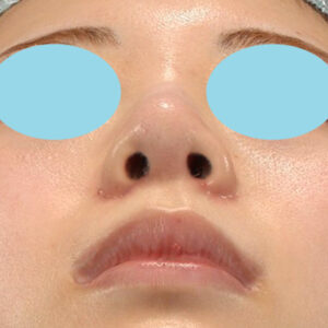 新宿ラクル美容外科クリニック　山本厚志　「貴族手術（鼻翼基部プロテーゼ）＋ 小鼻縮小+α法」　手術後１ヶ月目　３月３１日