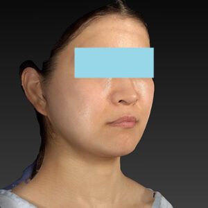 新宿ラクル美容外科クリニック　山本厚志　「ナチュラルフェイスリフト」「ライポライフ脂肪吸引（メーラーファット+ジョールファット）」　手術後１ヶ月目　３月２０日